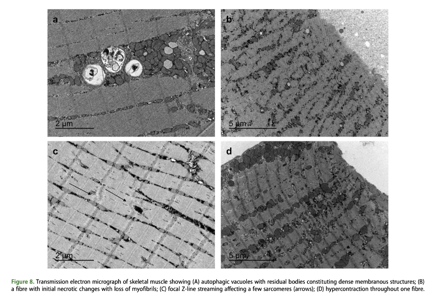 Importancia de la recuperación de 72 horas en las lesiones de isquiotibiales en Fútbol 72 horas recup 7 - Importancia de la recuperación de 72 horas en las lesiones de isquiotibiales en Fútbol